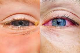 Seasonal eye allergies